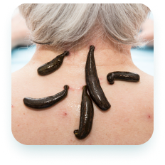 Medicinal leech therapy treatment
